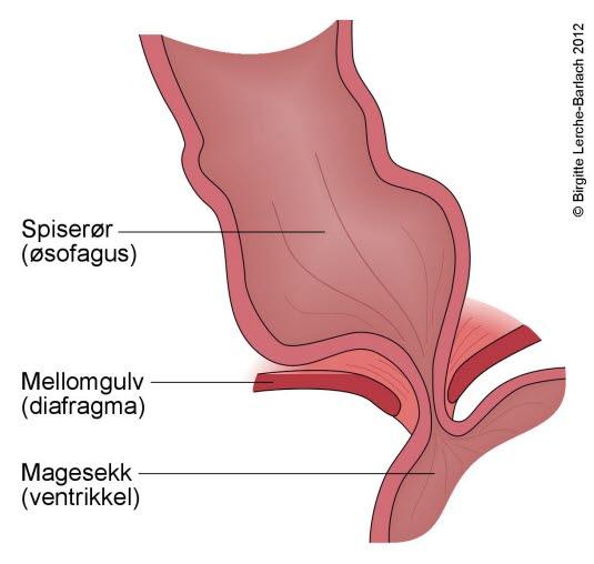 Nedre lukkemuskel i spiserøret Nedre lukkemuskel i spiserøret