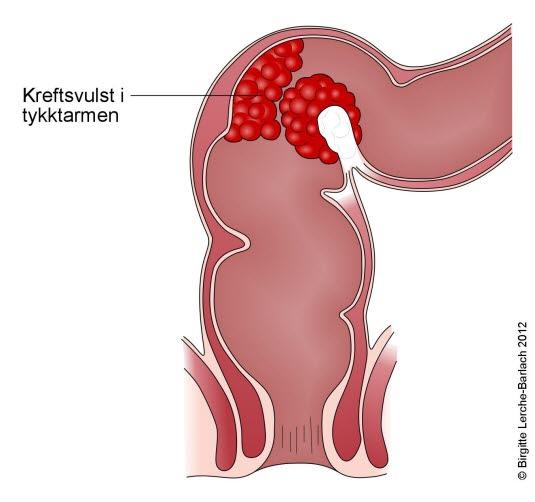 Tykktarmskreft, svulst i nedre del av tarmen Tykktarmskreft, svulst i nedre del av tarmen
