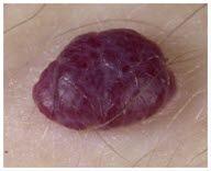 Hemangiom2 Hemangiom2