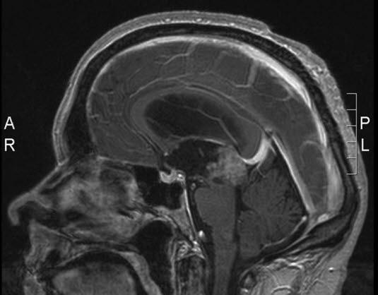 pineocytom 1 pineocytom 1