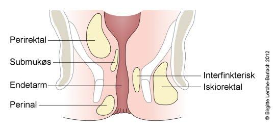 Analabscesser Analabscesser