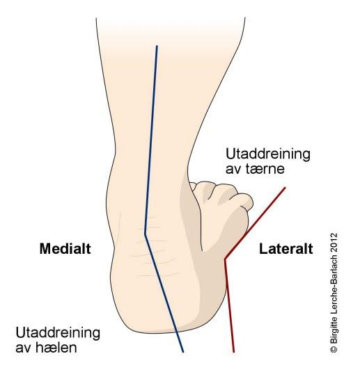 Ervervet plattfot, hælen sett bakfra Ervervet plattfot, hælen sett bakfra