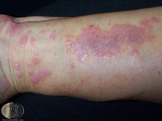 Lichen planus, Whickhams stria Lichen planus, Whickhams stria