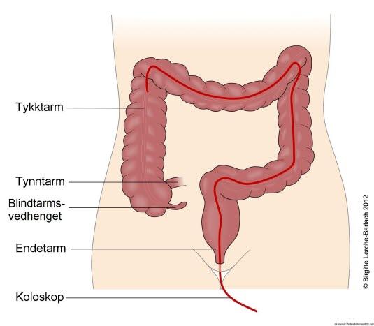Koloskopi Koloskopi