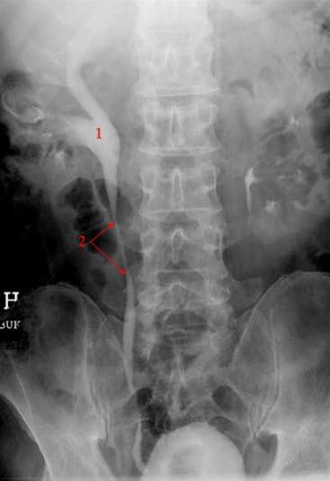 Hydronefrose vist på røntgen