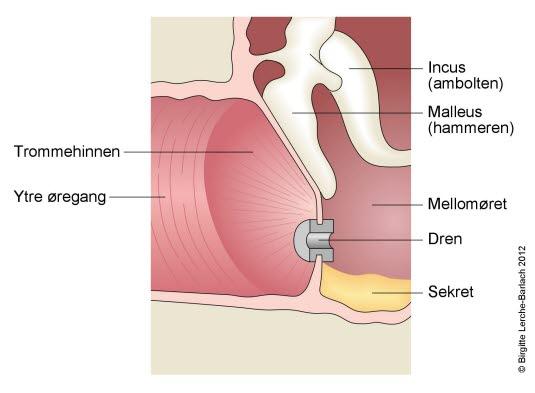 Trommehinne med dren sett fra siden Trommehinne med dren sett fra siden