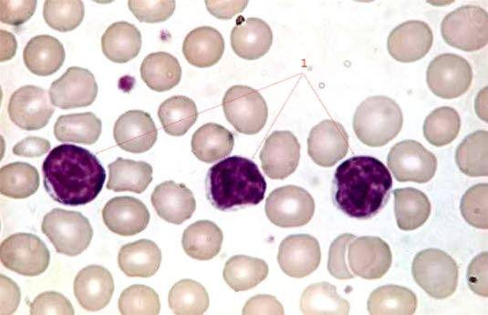 Kronisk lymfatisk leukemi (x 100) Kronisk lymfatisk leukemi (x 100)