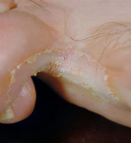 Fotsopp mellom tærne