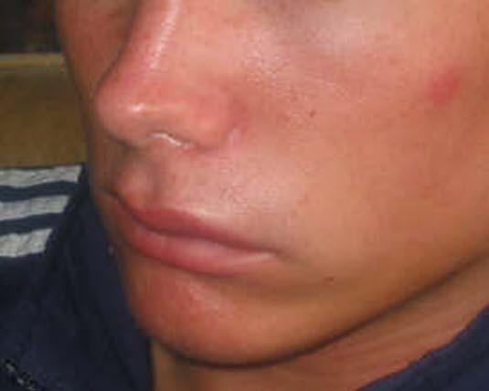 Hereditært angioødem Hereditært angioødem