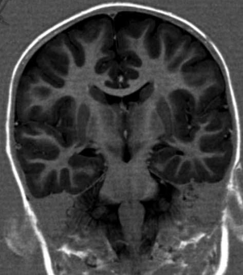 MS forandringer (MR koronarsnitt) MS forandringer (MR koronarsnitt)