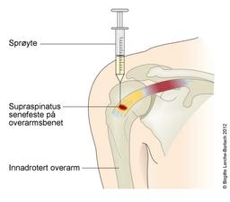 Injeksjon i supraspinatus Injeksjon i supraspinatus