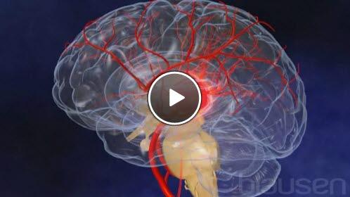 hjerneslag hjerneslag