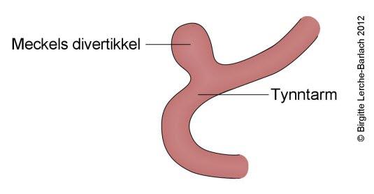 Meckels divertikkel Meckels divertikkel