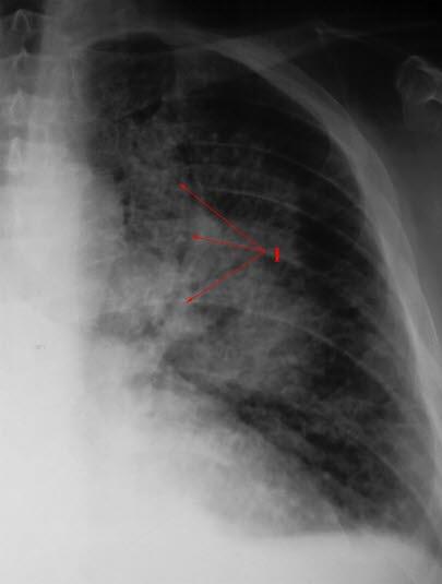 Røntgen av lungene som viser hjertesvikt Røntgen av lungene som viser hjertesvikt
