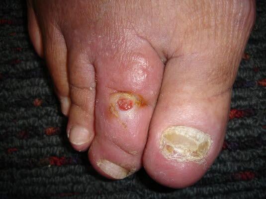 Fotsår, arterielt Fotsår, arterielt