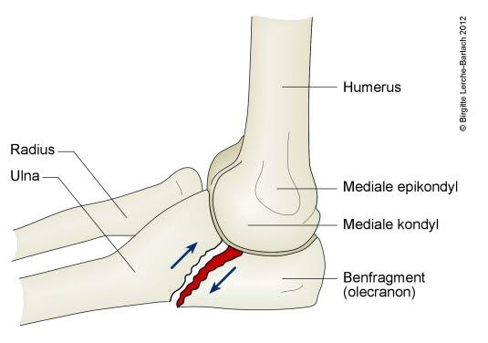 Brudd i ulna i albueleddet Brudd i ulna i albueleddet