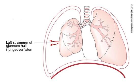 id349_pneumothorax totalis id349_pneumothorax totalis