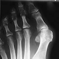 Hallux valgus Hallux valgus