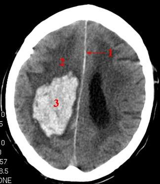 Cerebral blødning (CT) Cerebral blødning (CT)