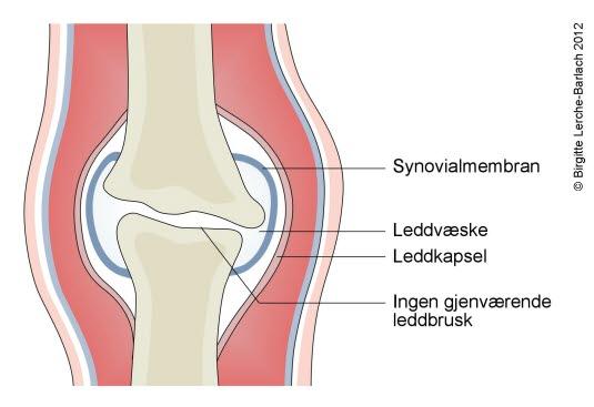Sluttstadium ved dårlig behandlet artritt Sluttstadium ved dårlig behandlet artritt