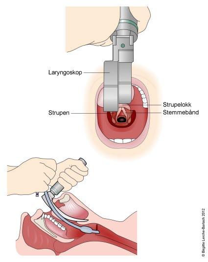 Laryngoskopi Laryngoskopi