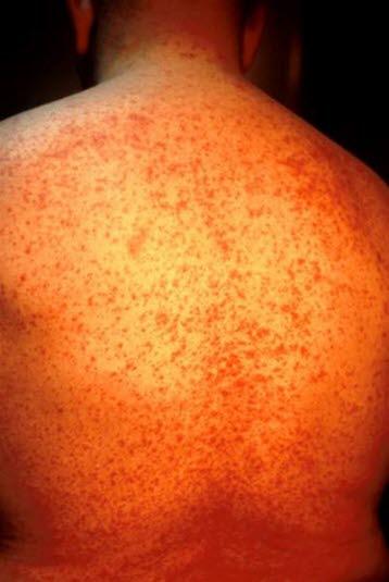 Makulopapuløst utslett, legemiddelreaksjon Makulopapuløst utslett, legemiddelreaksjon