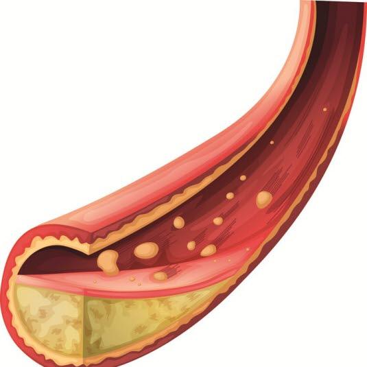 Aterosklerose Aterosklerose