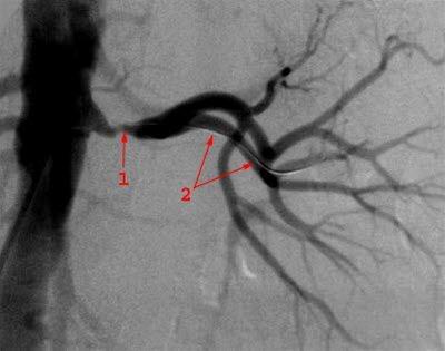 Nyrearteriestenose Nyrearteriestenose