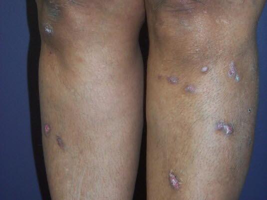 Lichen planus, hypertrofisk Lichen planus, hypertrofisk