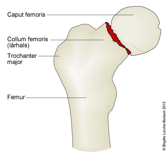 Lårhalsbrudd, mindre forskyvning Lårhalsbrudd, mindre forskyvning