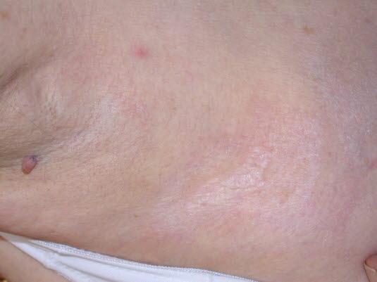 Lichen sclerosus Lichen sclerosus