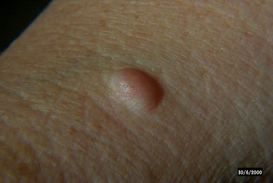 Nevrofibromatose, solitært nevrofibrom Nevrofibromatose, solitært nevrofibrom