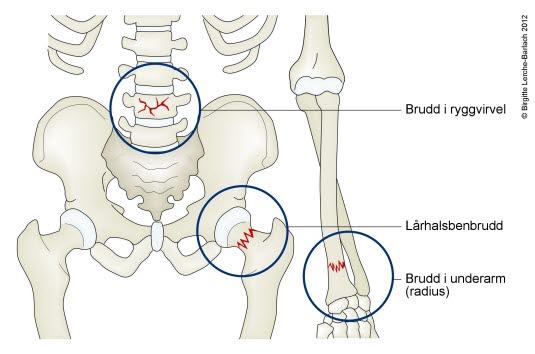 Brudd forårsaket av beinskjørhet Brudd forårsaket av beinskjørhet