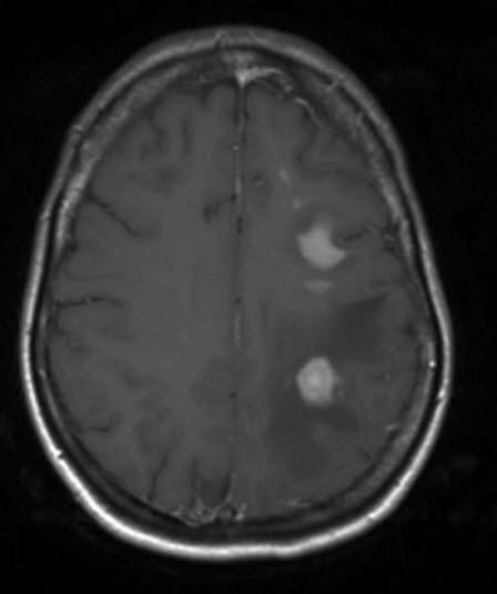 primært cns lymfom primært cns lymfom