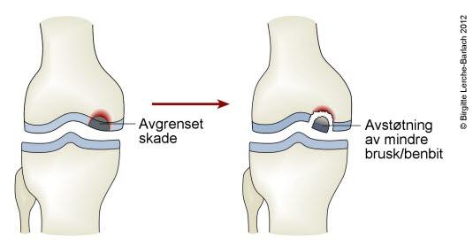 Kne - osteochondritt Kne - osteochondritt