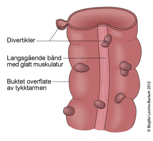 Tykktarmsdivertikler