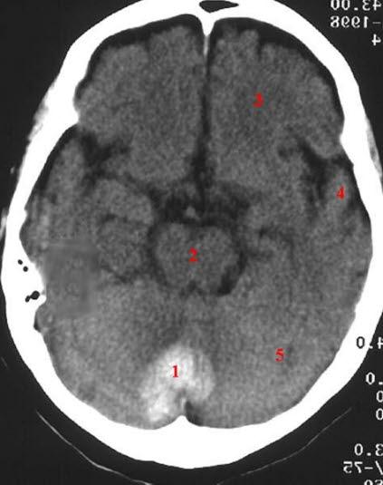Hematom i cerebellum Hematom i cerebellum