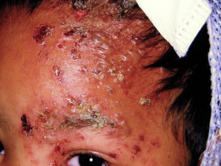 Zoster oftalmicus Zoster oftalmicus