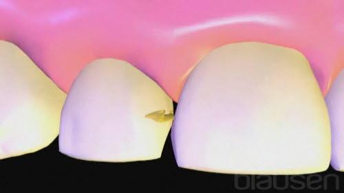 Tannråte (karies - "hull i tann") Tegning av tann med karies