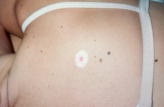 Nevus, halonevus Nevus, halonevus