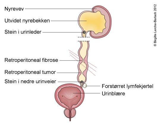 Hydronefrose Hydronefrose