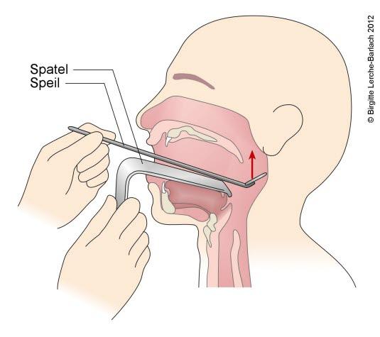Bakre rhinoskopi Bakre rhinoskopi