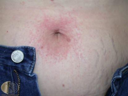 Contact eczema, periumbilical