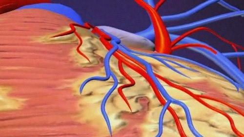 Koronar angiografi, animasjon