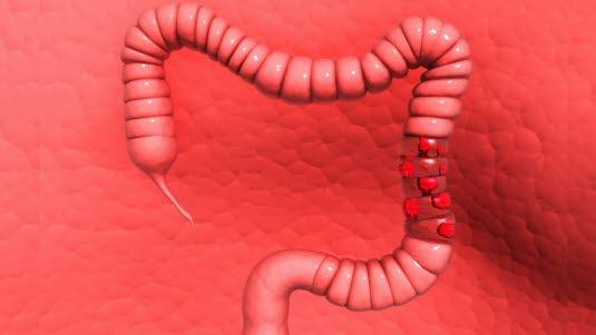 Tykktarm med polypper