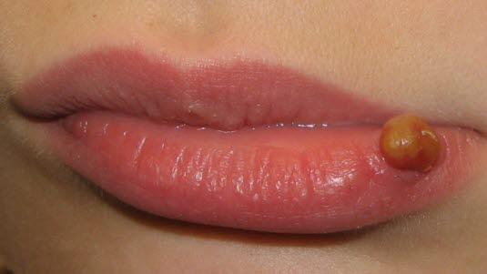 Pyogent granulom, leppe hos barn.jpg