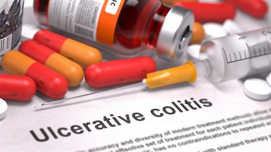 Ulcerøs kolitt