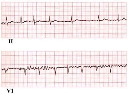 Atrial fibrillation, ECG