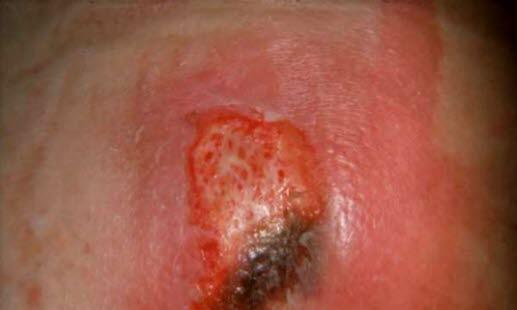 Pressure ulcer