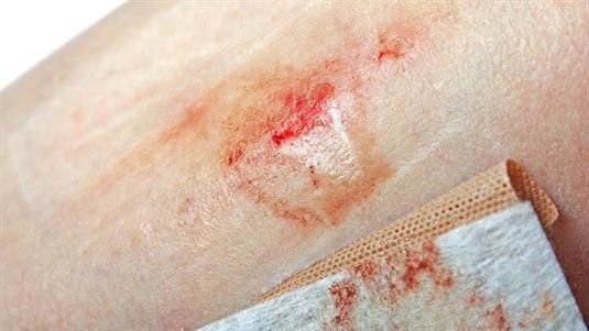 Skrubbsår Nærbildet av et skrubbsår på huden til en person.